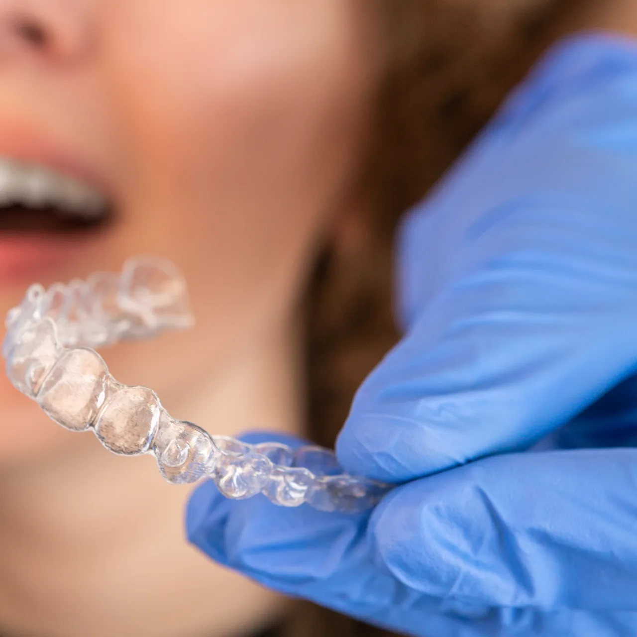 Clear aligner placement during an orthodontic visit